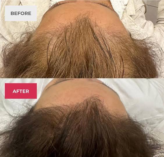 Purasomes hair and scalp complex Purasomes hair and scalp complex